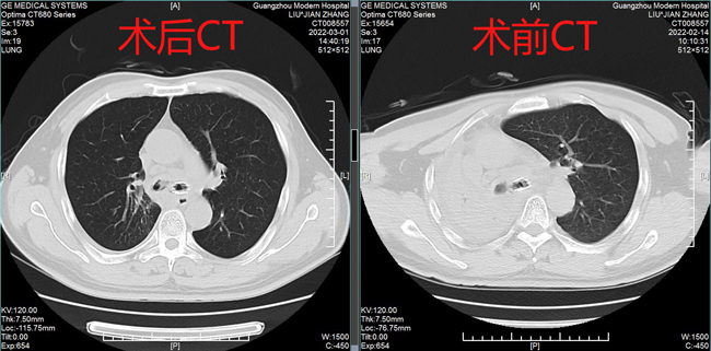 術(shù)前術(shù)后CT表現(xiàn)-2.jpg